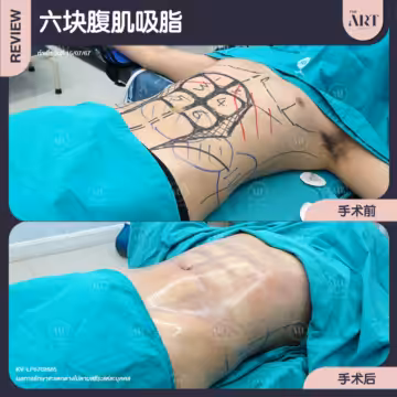 六块腹肌吸脂