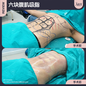 六块腹肌吸脂