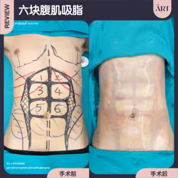 六块腹肌吸脂