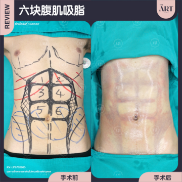 六块腹肌吸脂