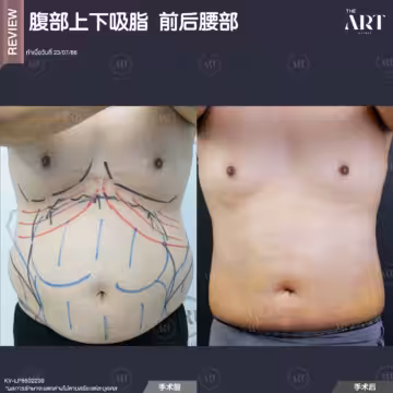 抽腹部脂肪