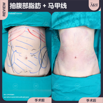 抽腹部脂肪 + 马甲线