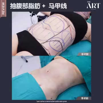 抽腹部脂肪 + 马甲线