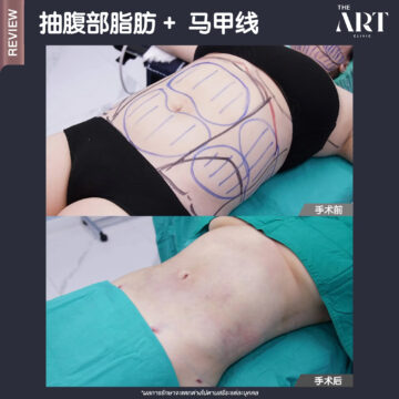 抽腹部脂肪 + 马甲线