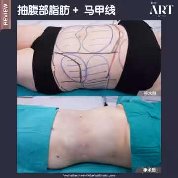 抽腹部脂肪 + 马甲线