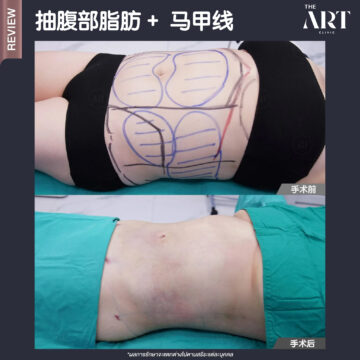 抽腹部脂肪 + 马甲线