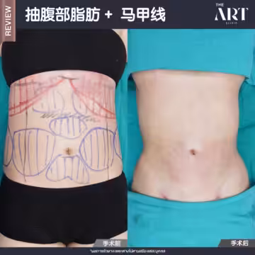 抽腹部脂肪 + 马甲线