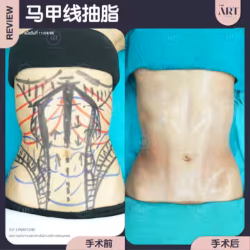 抽腹部脂肪 + 马甲线