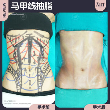 抽腹部脂肪 + 马甲线
