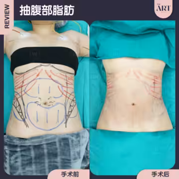 抽腹部脂肪