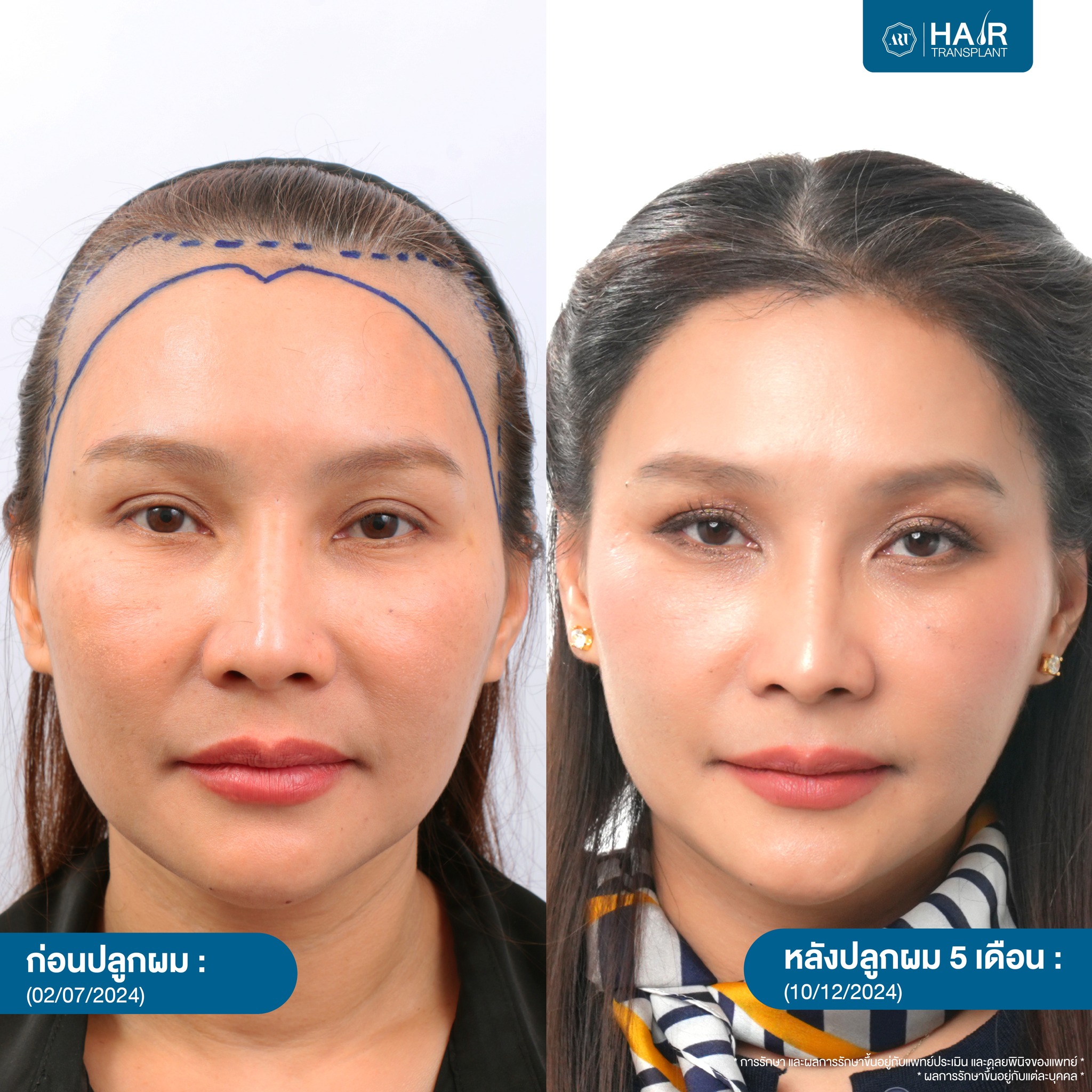 ปลูกผมผู้หญิง