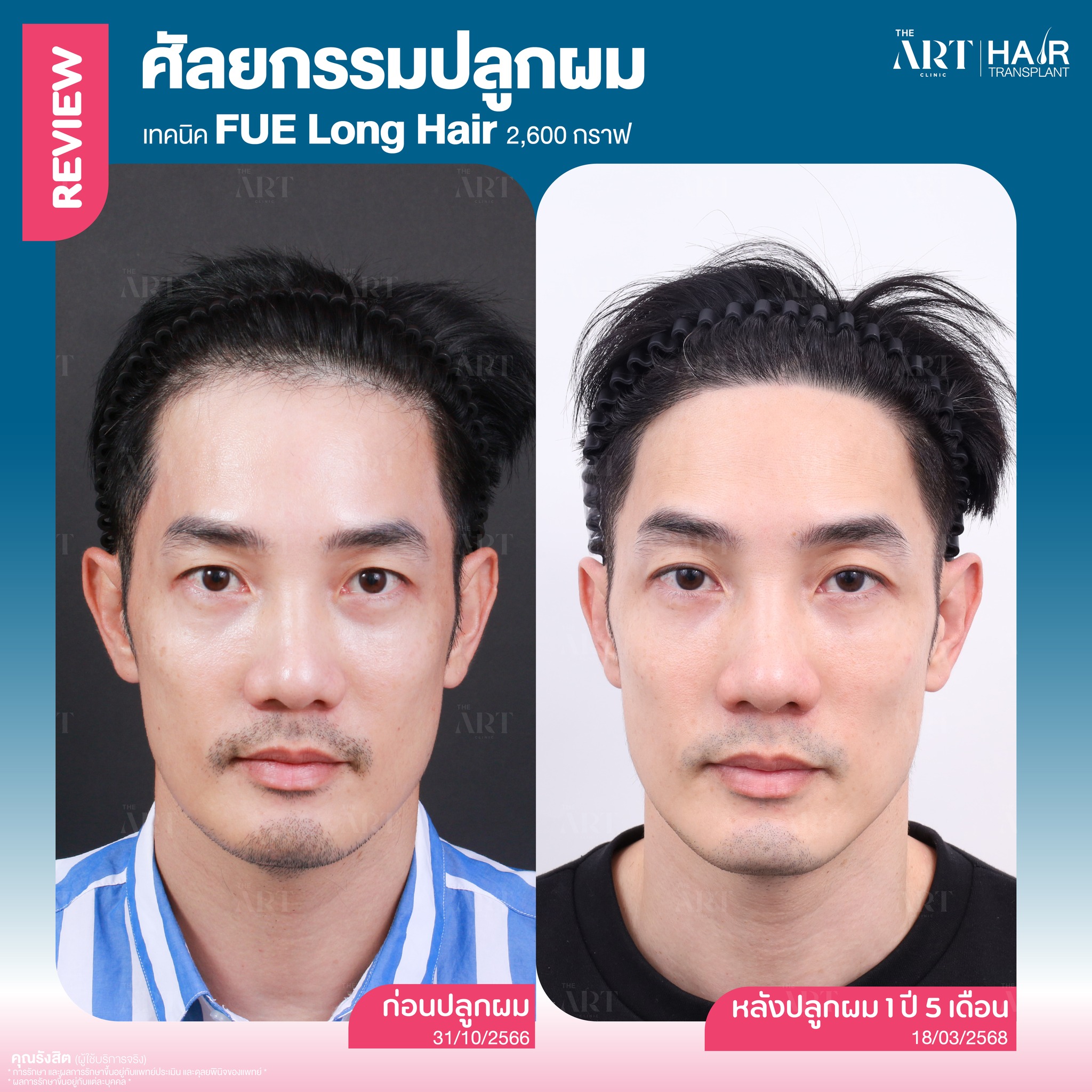 ปลูกผมผู้ชาย