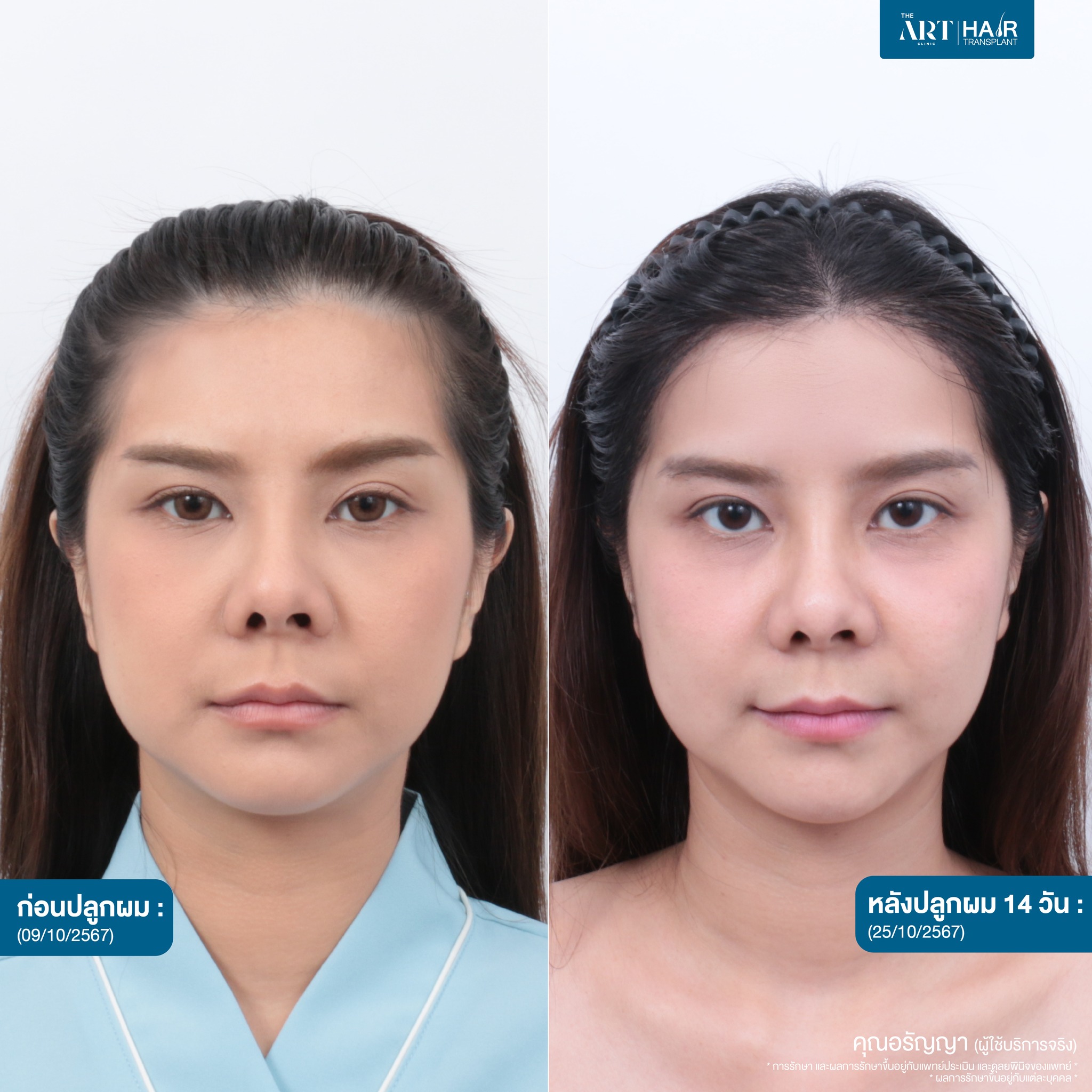 ปลูกผมผู้หญิง