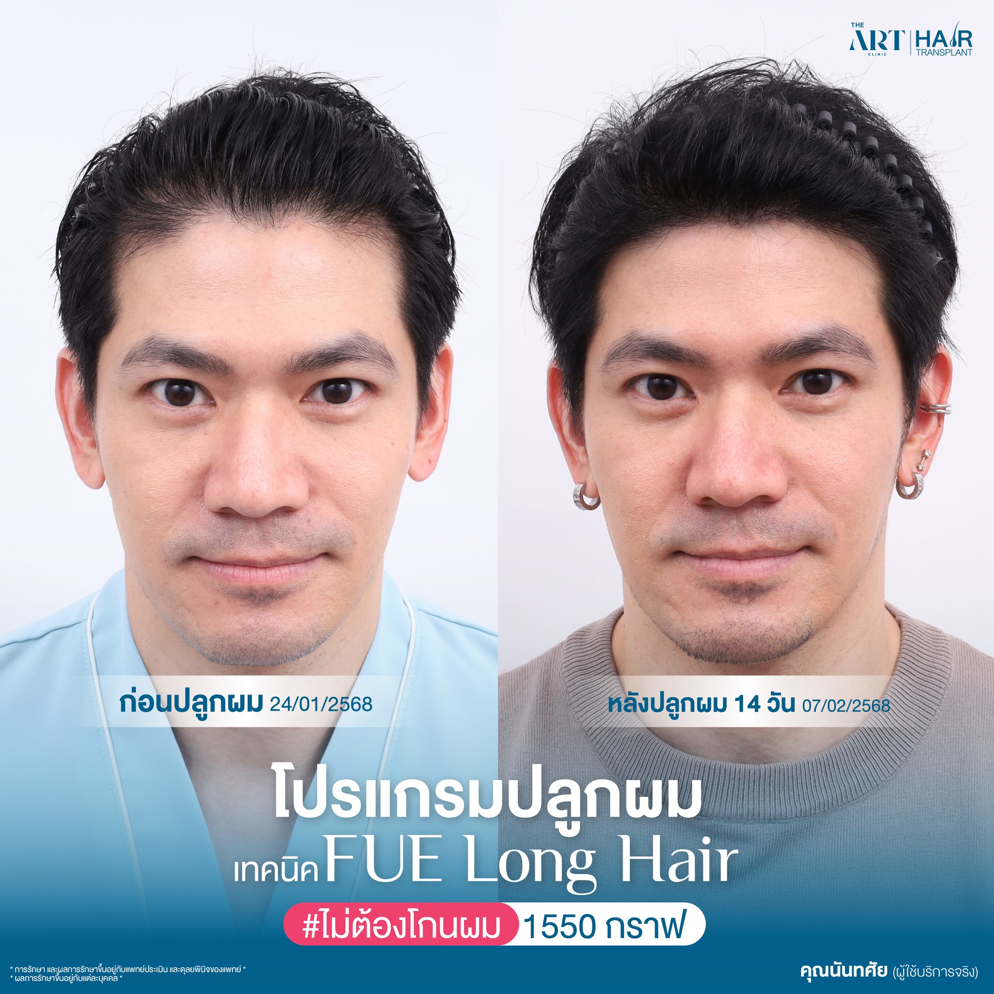 ปลูกผมผู้ชาย