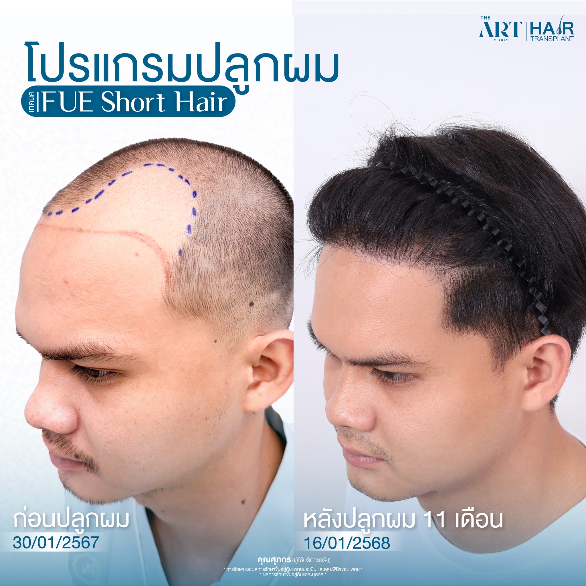 ปลูกผมผู้ชาย