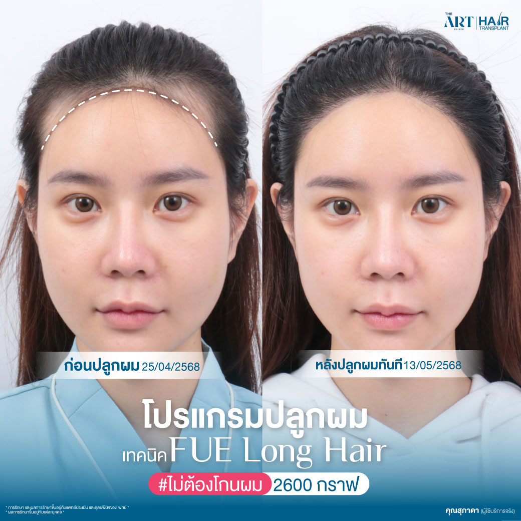 ปลูกผมผู้หญิง