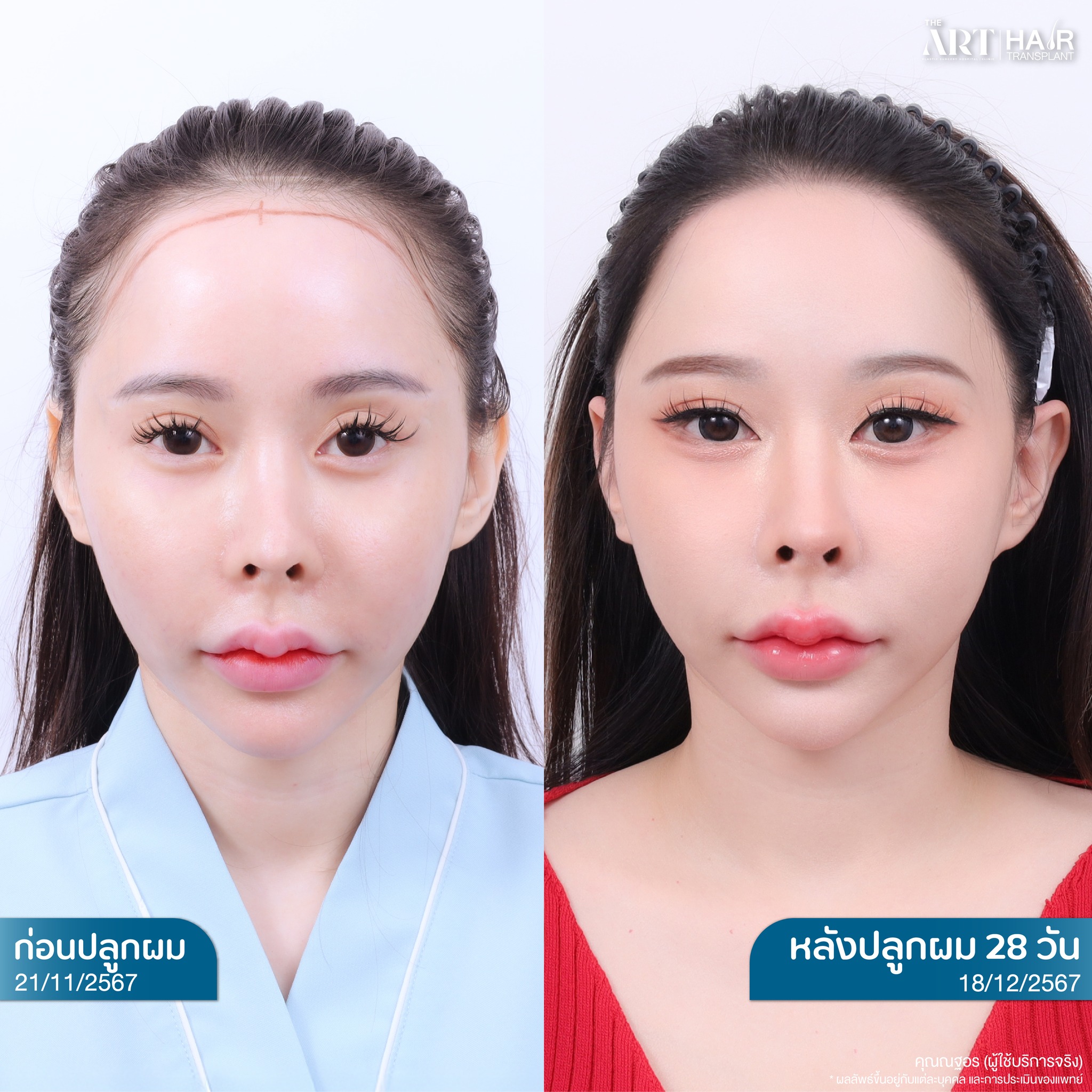 ปลูกผมผู้หญิง