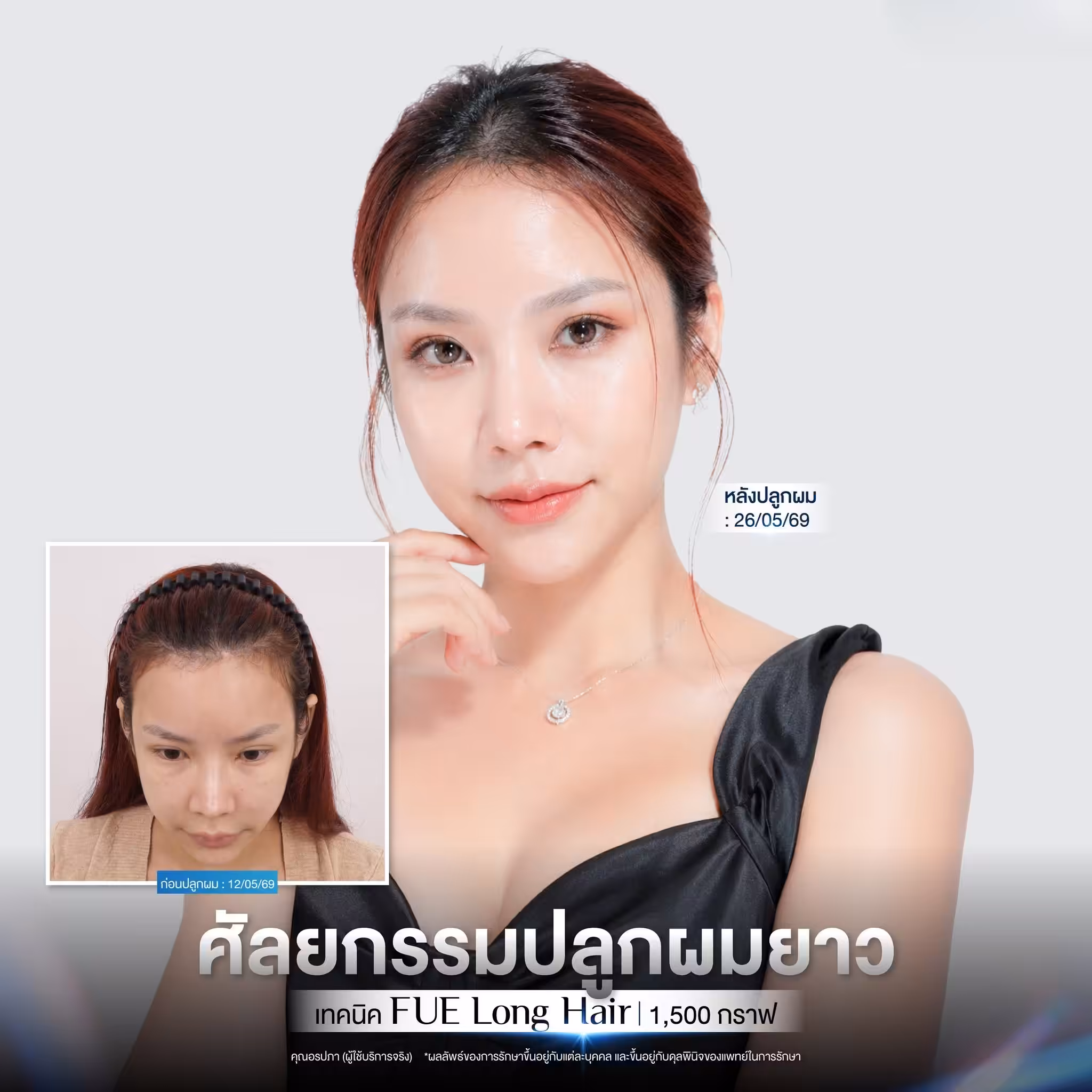 before-after The Art Hairline 001