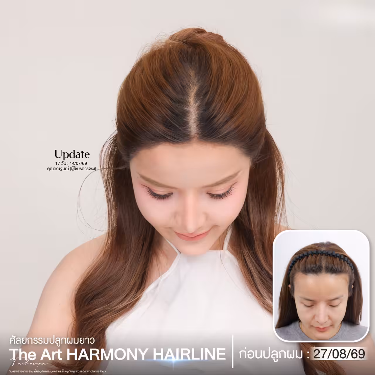 before-after The Art Hairline 002