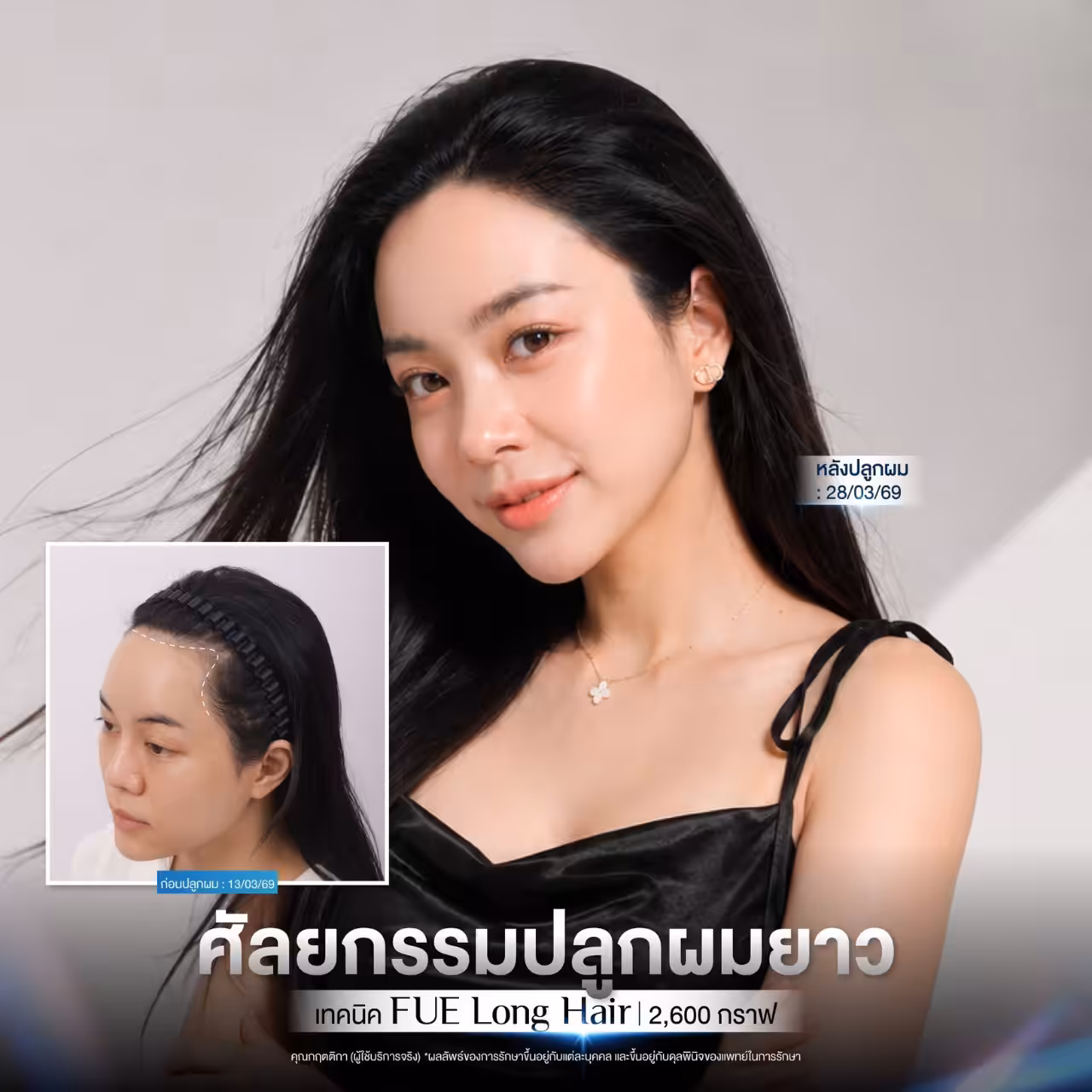 before-after The Art Hairline 002