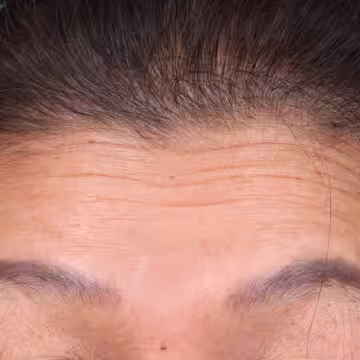 Upper facelift ใบหน้าส่วนบน (ดึงบริเวณขมับ หางตา หางคิ้ว โหนกแก้ม)