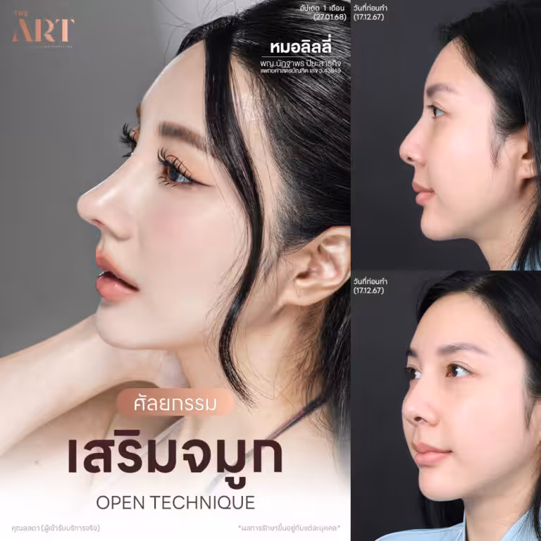 Ads-เสริมจมูก Open แฟชั่นเช็ต คุณลลดา
