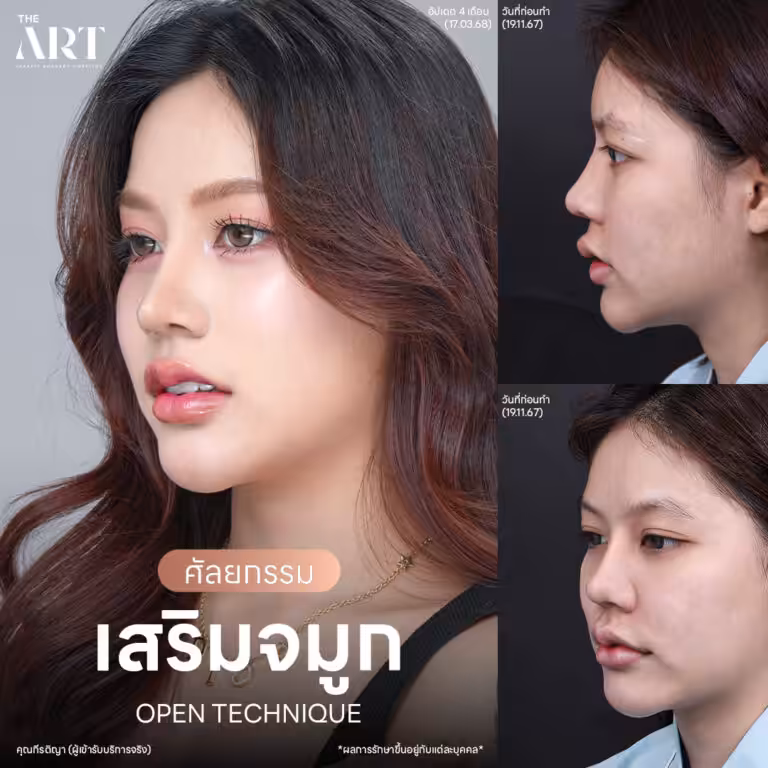 เสริมจมูก Open แฟชั่นเช็ต คุณกีรติญา