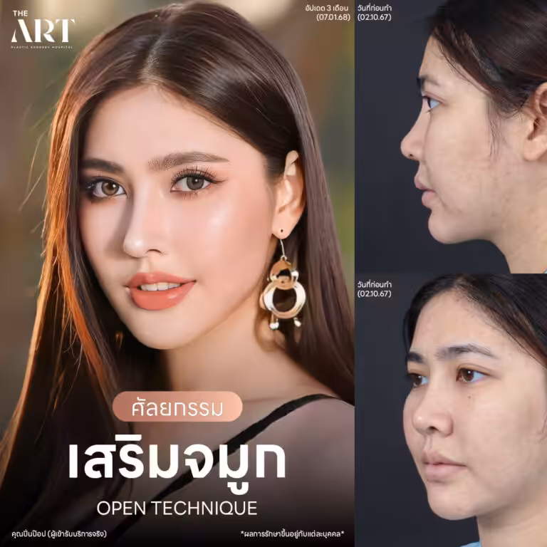 เสริมจมูก Open แฟชั่นเช็ต คุณปิ่นป๊อป