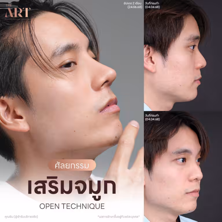 เสริมจมูก Open แฟชั่นเช็ต คุณยิม