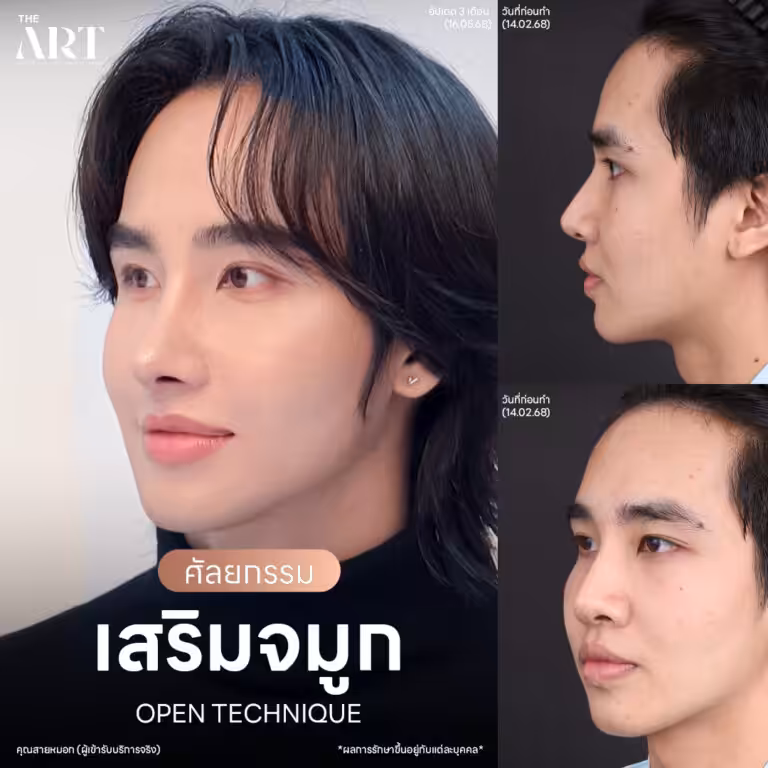 เสริมจมูก Open แฟชั่นเช็ต สายหมอก