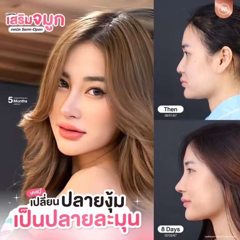 จมูก Triple Lock