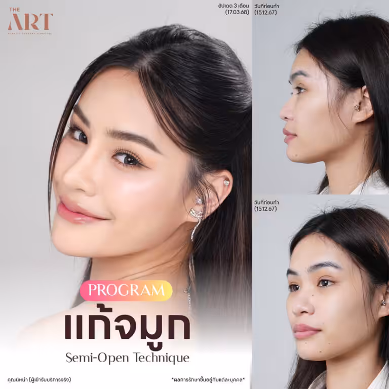 จมูก Triple Lock10