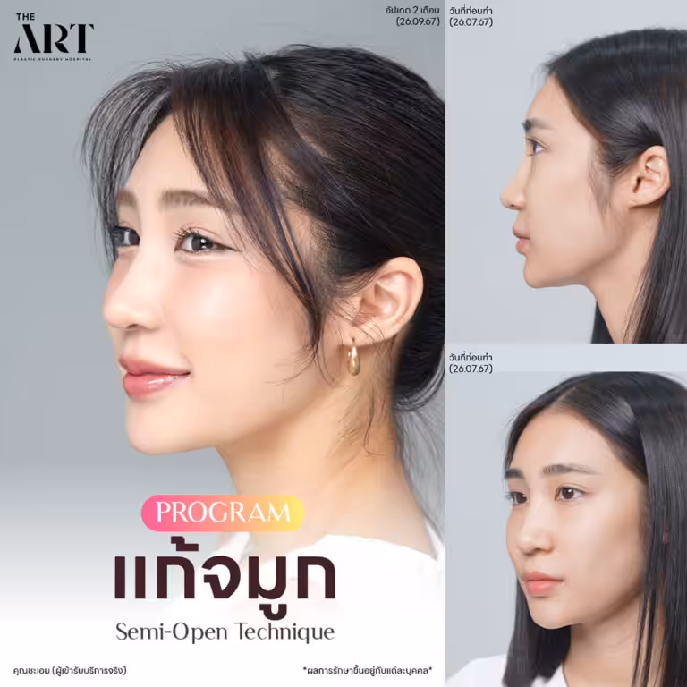 จมูก Triple Lock2