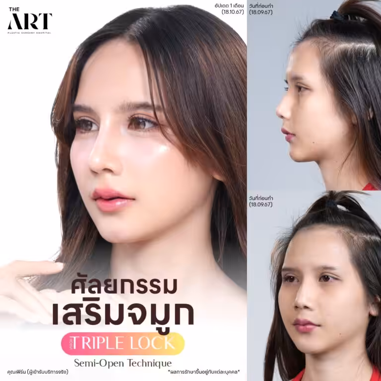 จมูก Triple Lock3