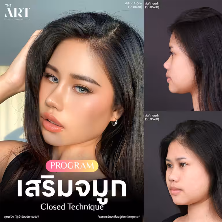จมูก Triple Lock5