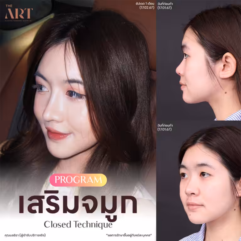จมูก Triple Lock7