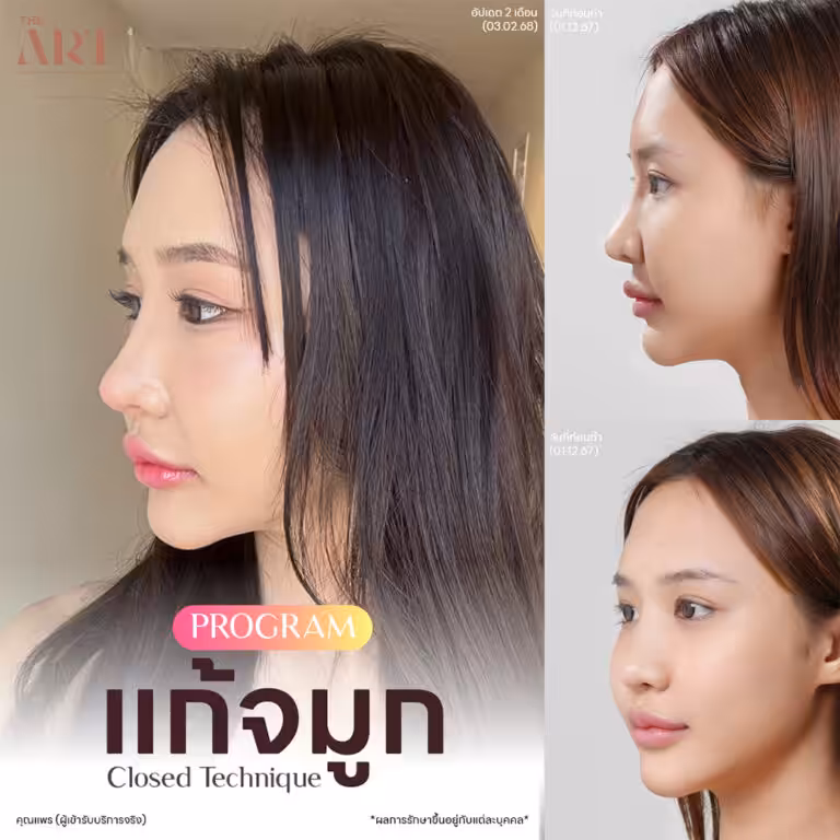 จมูก Triple Lock8