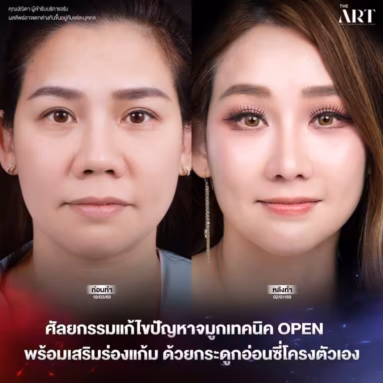 เสริมจมูกโอเพ่น