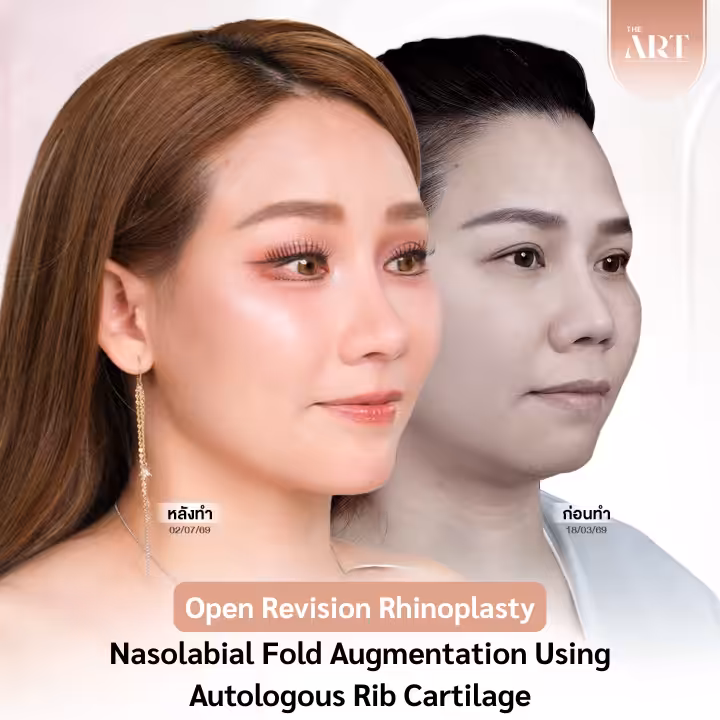 open revision rhionplasty