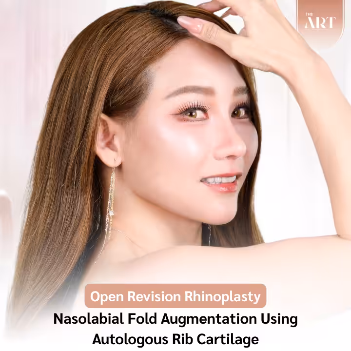 open revision rhionplasty