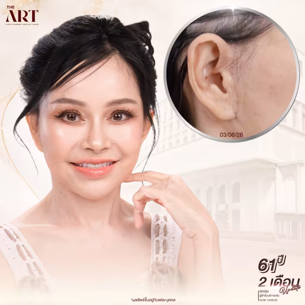 คุณจุง FullFacelift