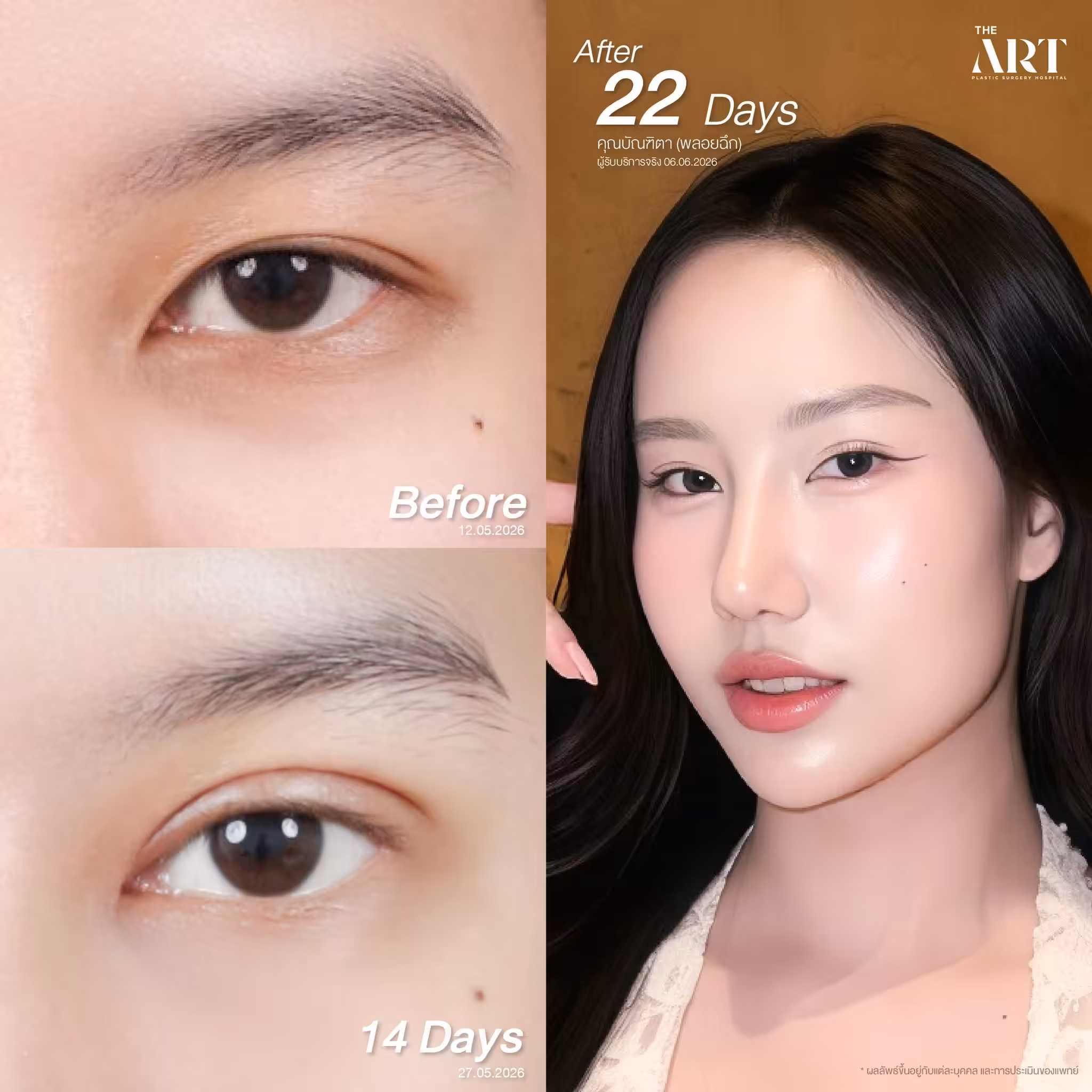 Review_double eyelid--002