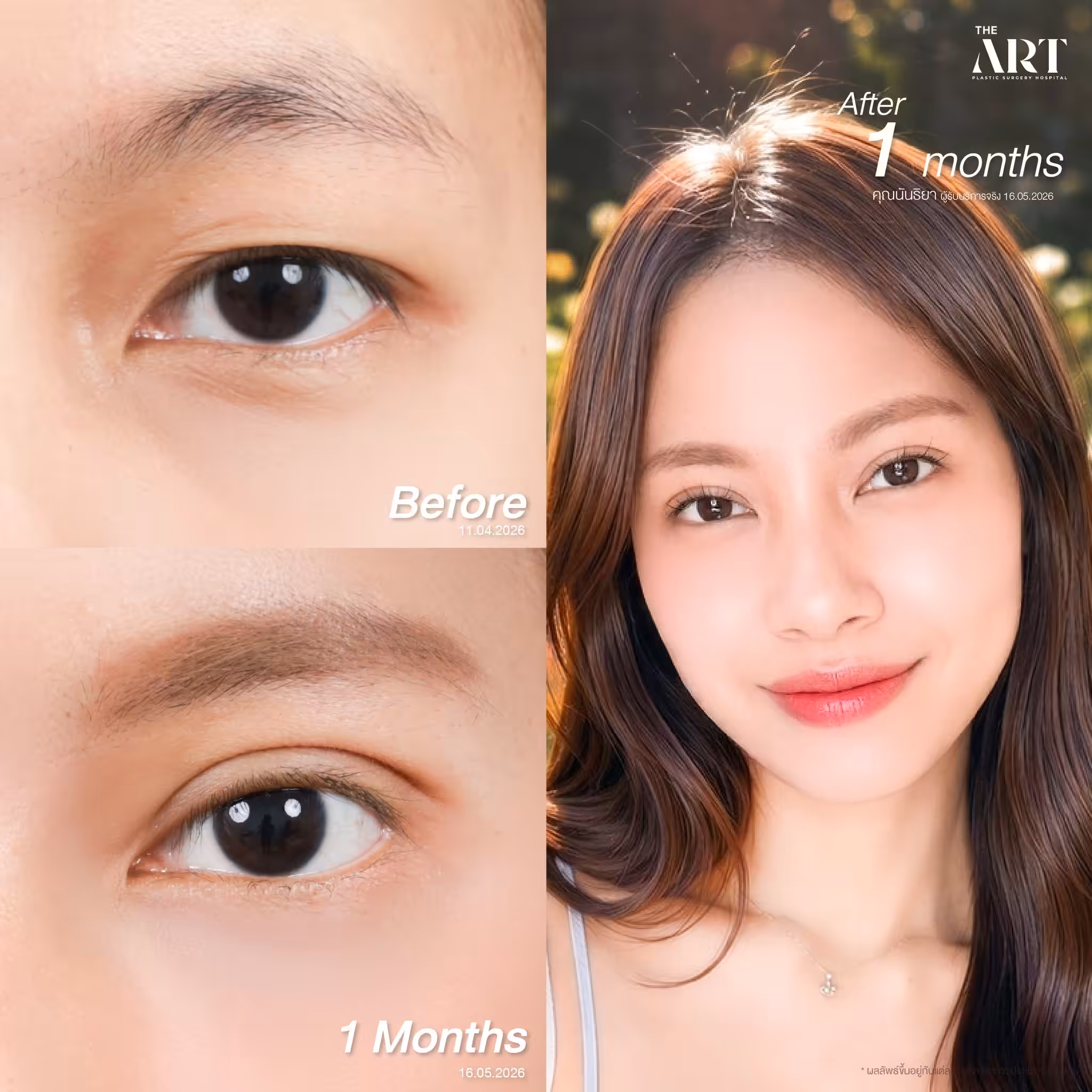 Review_double eyelid--003