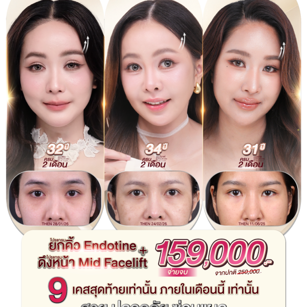 Mini Facelift โปรแกรมดึงหน้าส่วนกลาง