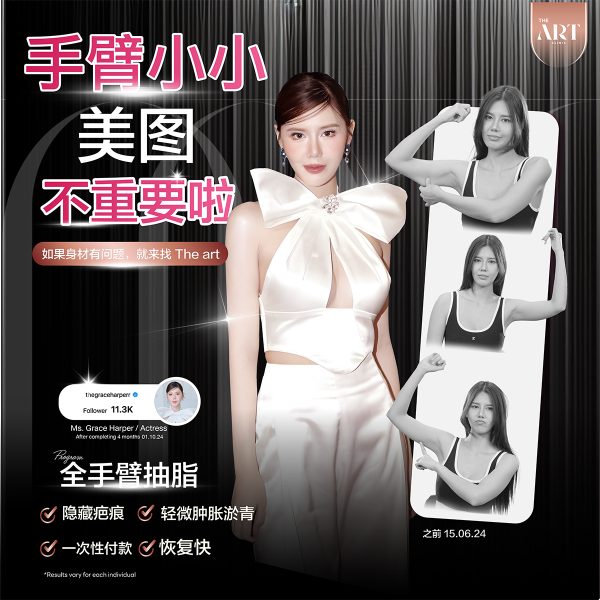 11_02_68-ดูดไขมันแขน-XH-CHI