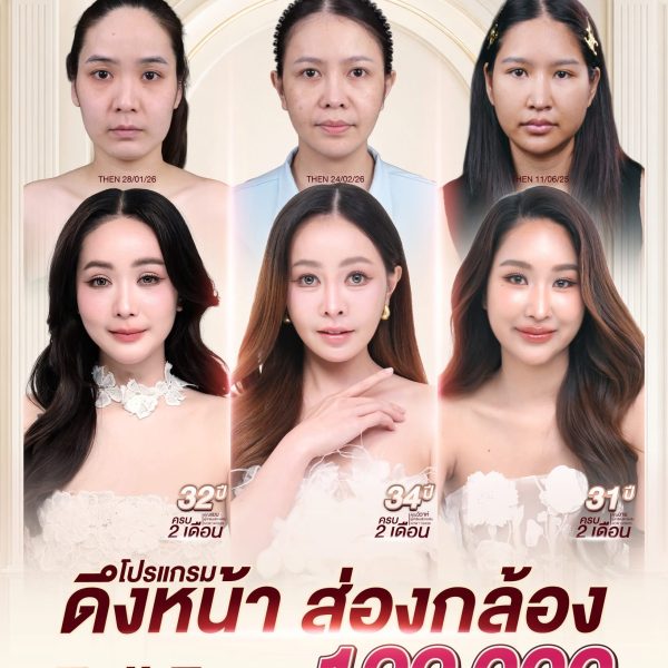 โปรโมชั่นดึงหน้า Full Face ส่องกล้อง
