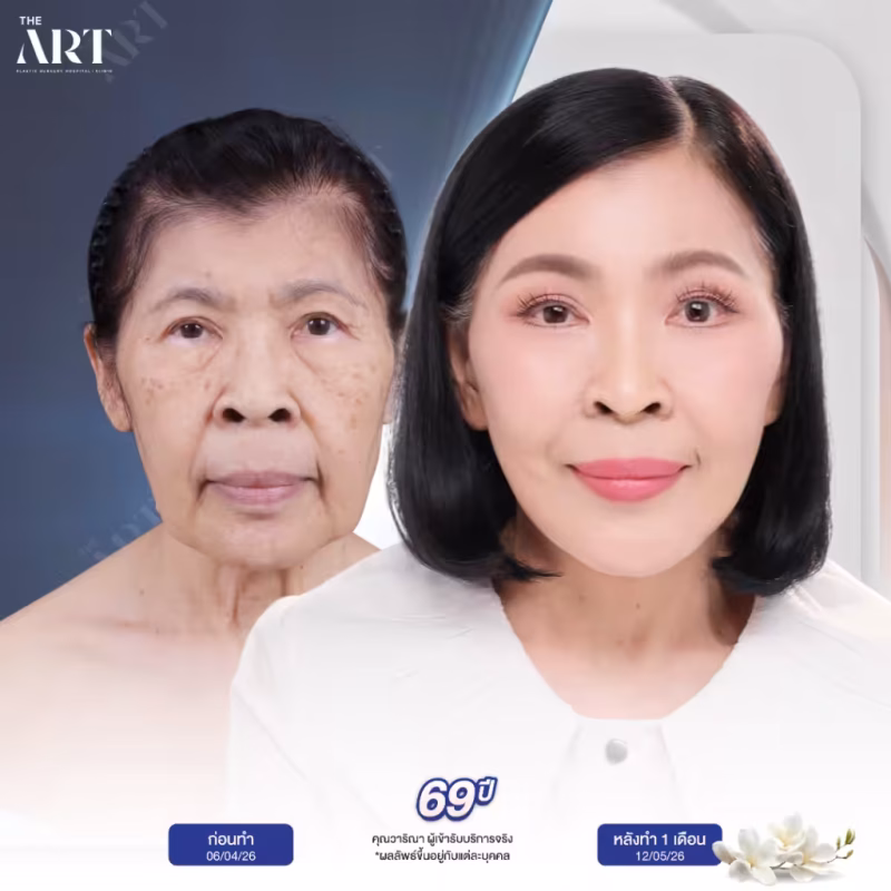 Facelift mother day20206_003