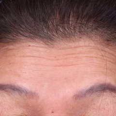 Upper facelift ใบหน้าส่วนบน (ดึงบริเวณขมับ หางตา หางคิ้ว โหนกแก้ม)