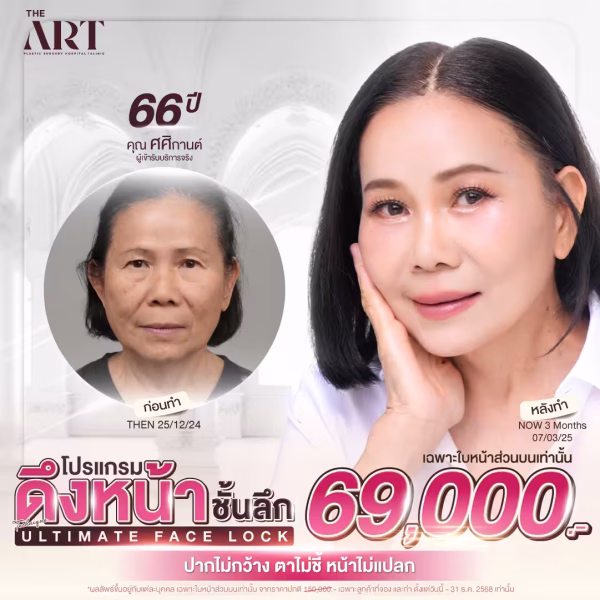 โปรโมชั่นดึงหน้าชั้นลึก Ultimate Face Lock ที่ The Art Hospital ราคา 69,000 บาท พร้อมผลลัพธ์หลังทำจริงด้วยเทคนิคเฉพาะทาง