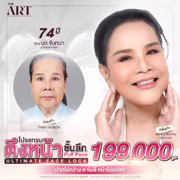 โปรโมชั่นดึงหน้าชั้นลึก Ultimate Face Lock แบบ Full Face ที่ The Art Hospital ราคา 199,000 บาท พร้อมผลลัพธ์หลังทำจริงด้วยเทคนิคเฉพาะทาง